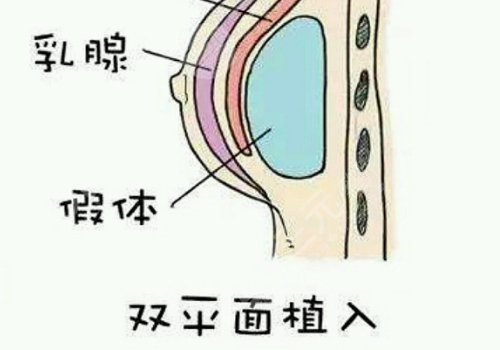 雙平面假體隆胸弊端優(yōu)缺點(diǎn)
