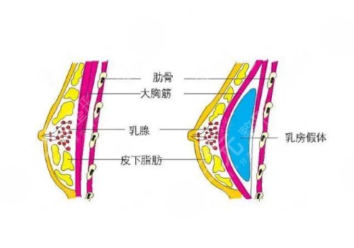 雙平面假體隆胸弊端優(yōu)缺點(diǎn)