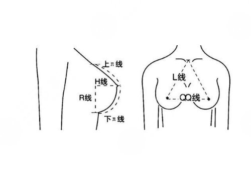 雙平面假體隆胸弊端優(yōu)缺點(diǎn)