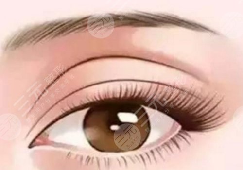 鄭州天后做單側(cè)雙眼皮提肌需要多少錢