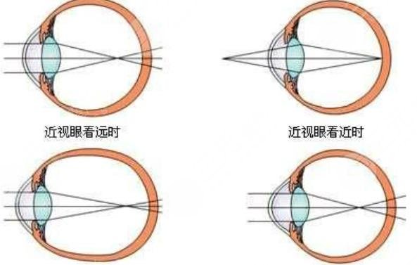 近視眼