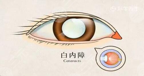 白內障