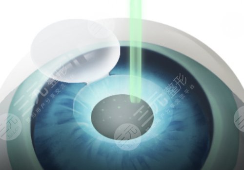 上海長海醫(yī)院近視手術(shù)怎么樣