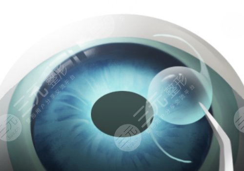 上海長海醫(yī)院近視手術(shù)怎么樣