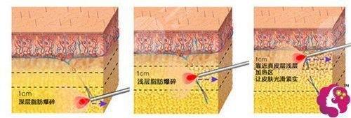 齊永樂醫(yī)生吸脂瘦大腿案例