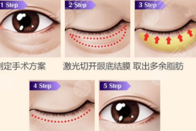 激光去眼袋原理
