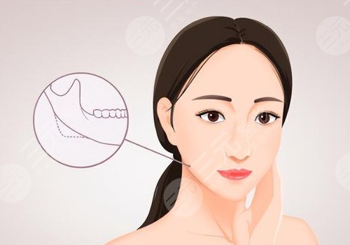 下頜骨整容整形的方法