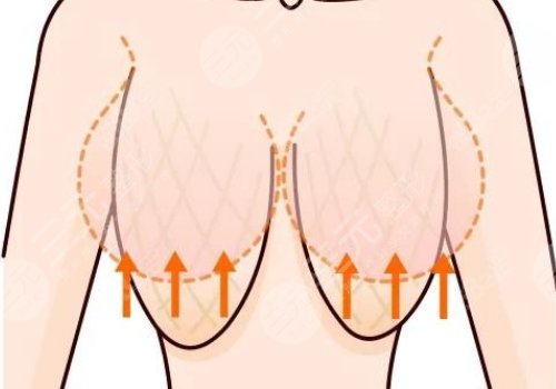 上海九院做胸下垂緩解好嗎，多少錢