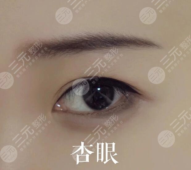 雙眼皮手術(shù)