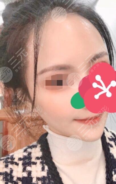 劉文先醫(yī)生玻尿酸注射填充太陽穴案例