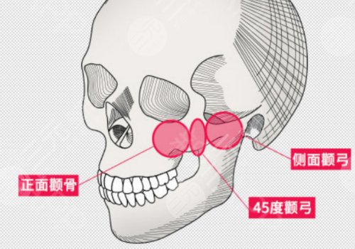 上海伊萊美削骨怎么樣