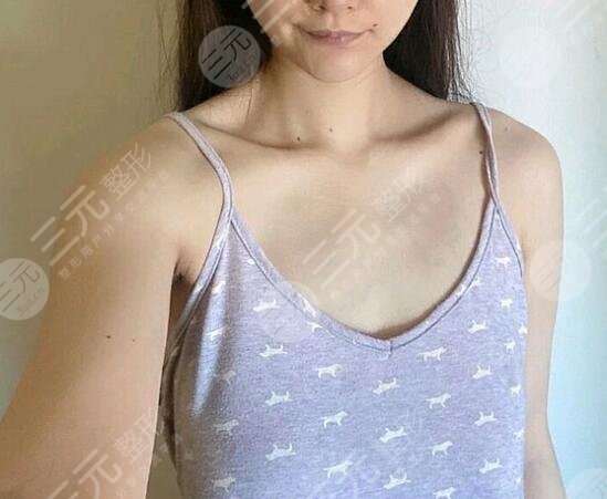 水滴型假體隆胸前后對(duì)比效果圖片和手術(shù)過(guò)程分享，小白隆胸避坑！