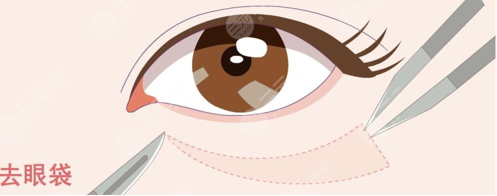 眼袋切除手術(shù)