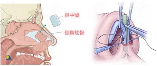 張明興醫(yī)生肋骨隆鼻案例