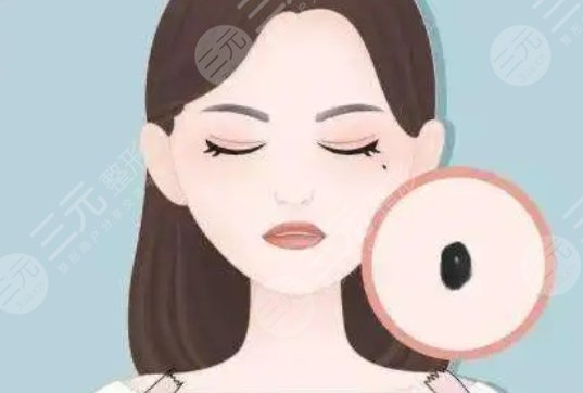 上海同濟醫(yī)院激光去痣案例