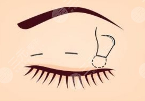 覃方燕做雙眼皮怎么樣