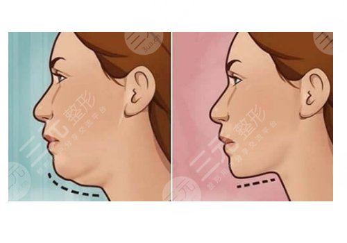 整容下巴需要花費多少錢呢