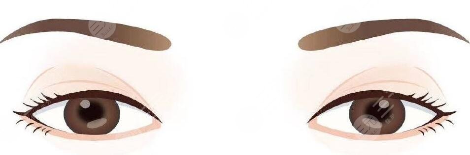 雙眼皮