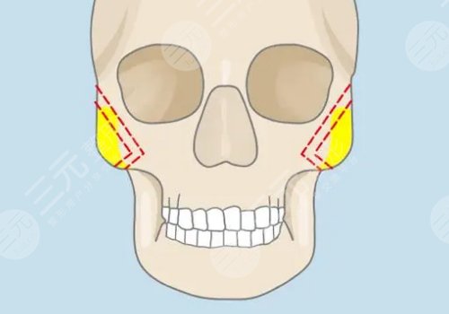 上海九院顴骨內(nèi)推醫(yī)生 