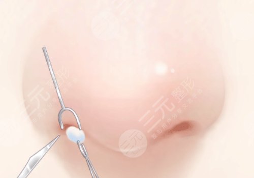 武漢曾佳醫(yī)生做鼻子