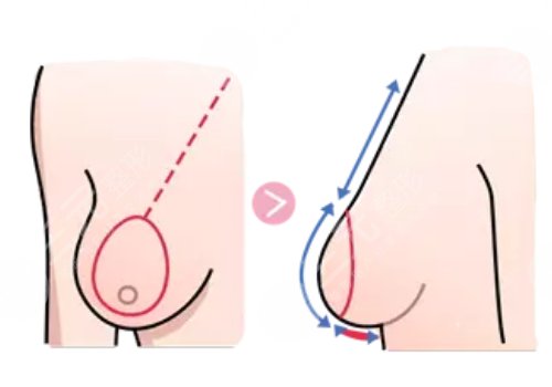 胸大可以做手術變小嗎