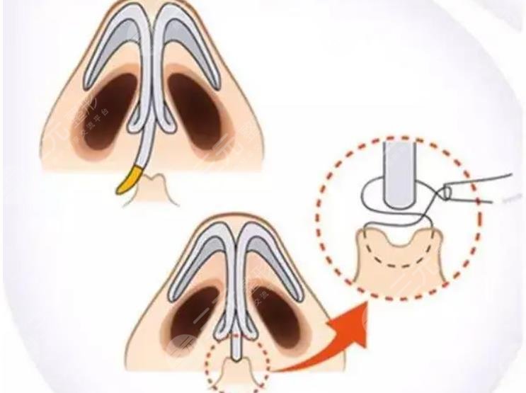 北京李勁良做鼻子價(jià)格?貴嗎