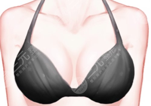 上海九醫(yī)院徐華和王濤乳房再造哪個(gè)好