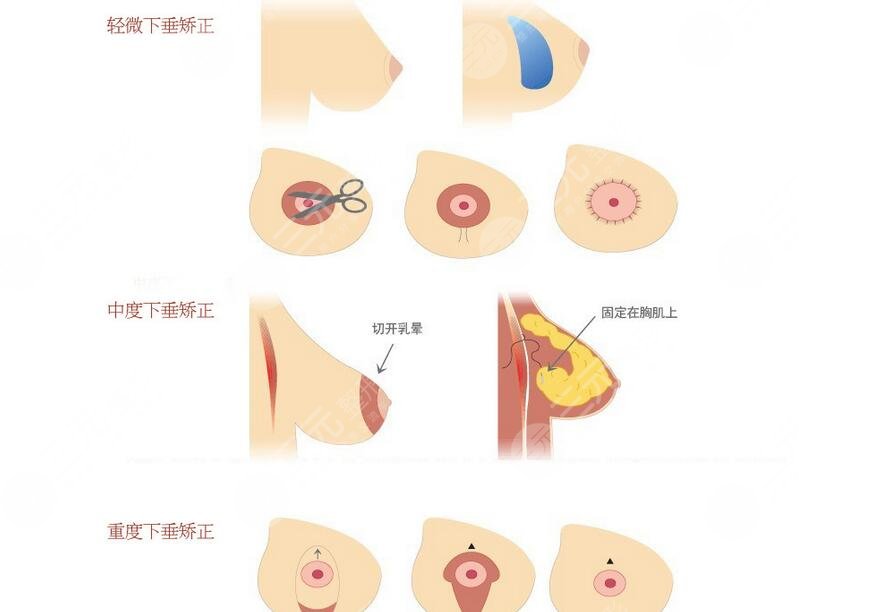 徐國(guó)建做胸部懸吊怎么樣