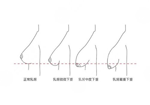隆胸懸吊的效果好嗎