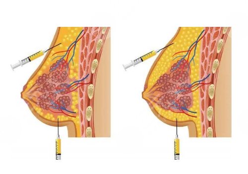 欒芳醫(yī)生隆胸怎么樣