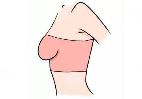 大胸下垂可以做縮胸手術(shù)嗎