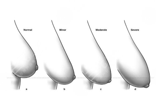 胸下垂外擴有什么辦法能挺起來