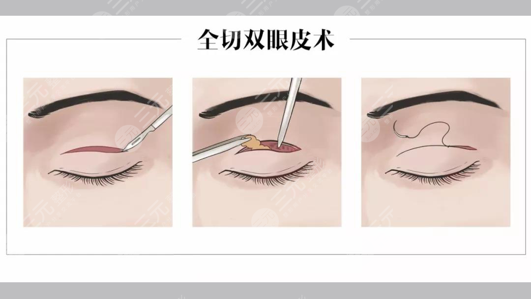 合肥李小靜雙眼皮案例分享！安醫(yī)附院整形實(shí)力派，醫(yī)生風(fēng)格揭秘~