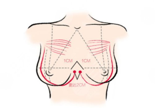 長沙湘雅二醫(yī)院隆胸貴嗎