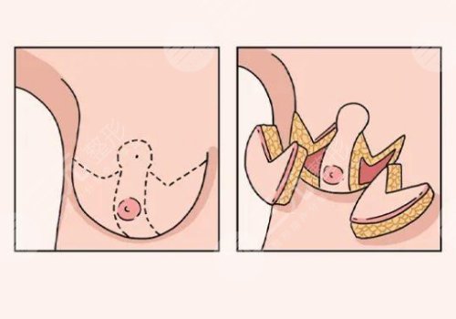 珠江醫(yī)院縮胸多少錢