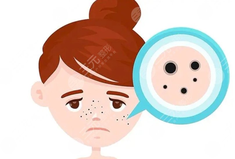 李曉陽(yáng)醫(yī)生激光祛斑案例