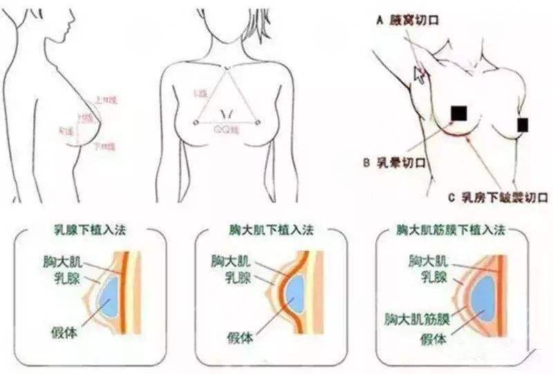 雙平面隆胸從哪里切口