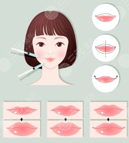 蔣萱醫(yī)生做唇案例