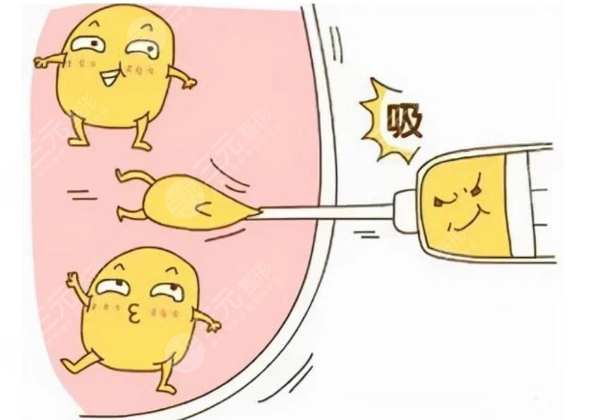 何永強醫(yī)生吸脂塑形手術案例