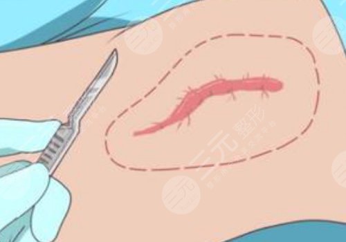 汕頭萊美醫(yī)療美容門診部祛疤怎么樣