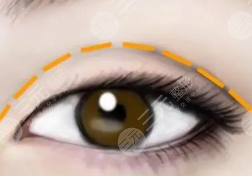 武漢郭亮醫(yī)生做雙眼皮手術(shù)多少錢(qián)