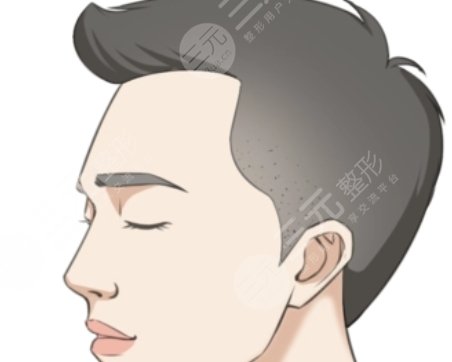 鬢角毛發(fā)種植