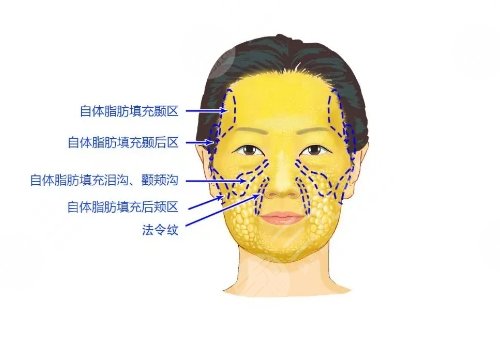 汕頭市中心醫(yī)院整形脂肪填充多少錢