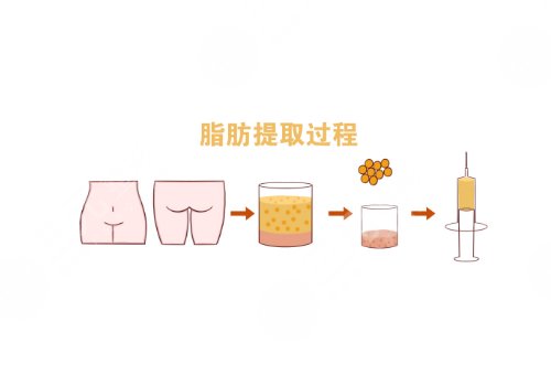 汕頭市中心醫(yī)院整形脂肪填充多少錢