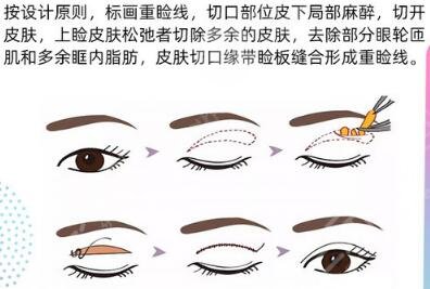 濟(jì)南王清峰雙眼皮做得怎么樣？醫(yī)生技術(shù)特點(diǎn)、案例反饋分享！