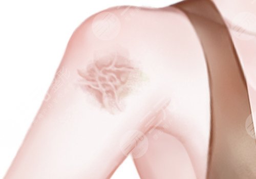 汕頭紫齡醫(yī)療美容門診部祛疤多少錢