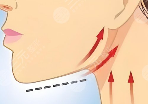 下顎線整形多少錢