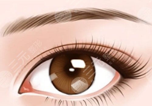 三眼皮迅速恢復(fù)雙眼皮