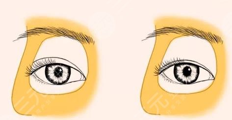 雙眼皮修復(fù)