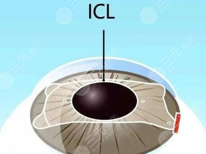 人工晶體植入術(shù)